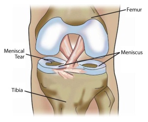 meniscus torn