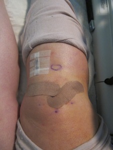 Close up of post-surgery knee